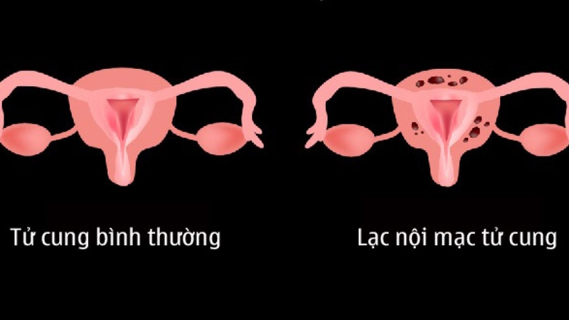 Liệu u nang buồng trứng có quan hệ được không? 2