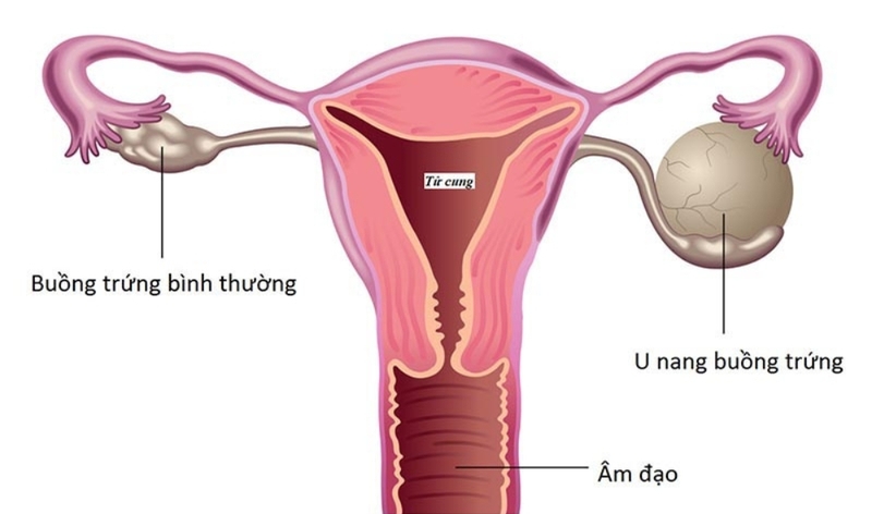 U nang buồng trứng là gì? U nang buồng trứng có phải mổ không?