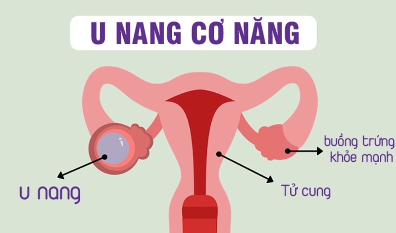 U nang buồng trứng là gì? U nang buồng trứng có phải mổ không? 2