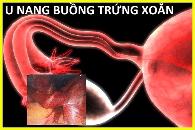 Giải đáp: U nang buồng trứng uống thuốc gì nhanh khỏi 1