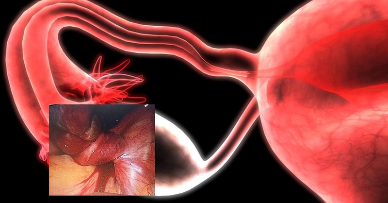 U nang buồng trứng xoắn: Triệu chứng, nguyên nhân và cách điều trị 1