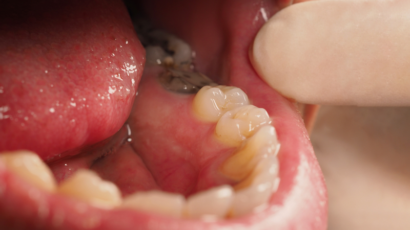 U nang răng: Nguyên nhân, triệu chứng và phương pháp điều trị 1