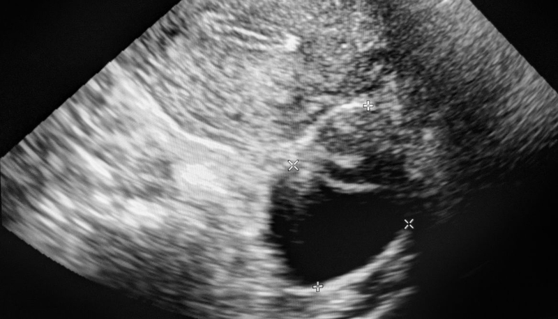 U nang và u xơ: Có gì khác biệt giữa hai loại u này 2