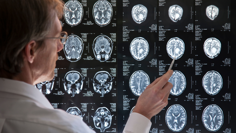 U não ác tính có chữa được không? Các phương pháp điều trị u não ác tính 1