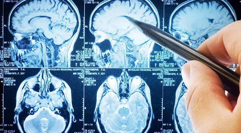 U não có chữa được không? Những phương pháp điều trị u não phổ biến nhất 2