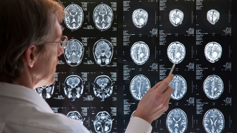 U não lành tính sống được bao lâu? Phòng bệnh ra sao? 1