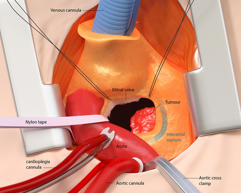 U nhầy nhĩ trái: Nguyên nhân, triệu chứng, chẩn đoán và phương pháp điều trị 1