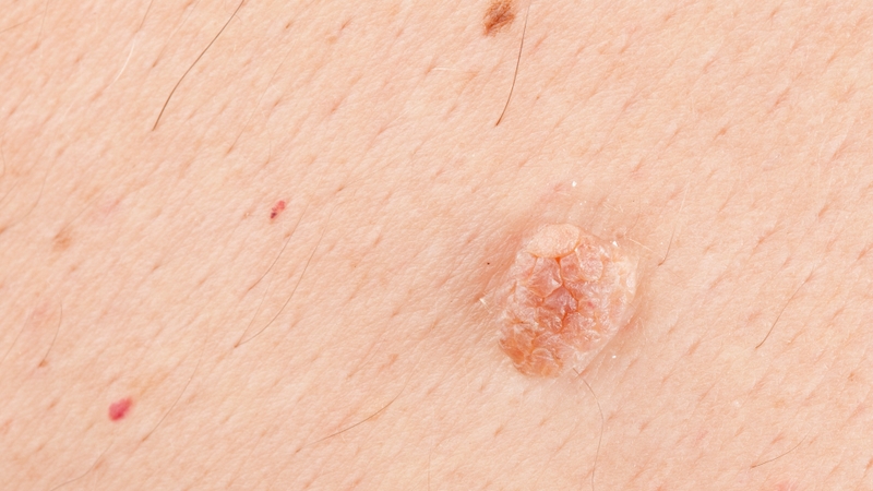 U nhú hậu môn: Nguyên nhân, triệu chứng và phương pháp điều trị hiệu quả 4