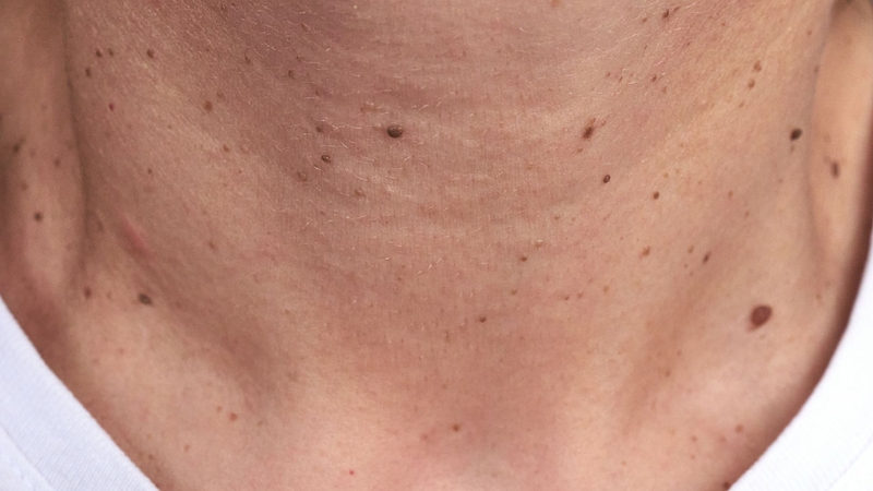 U nhú lành tính là gì? Phân loại và cách xử lý hiệu quả 4