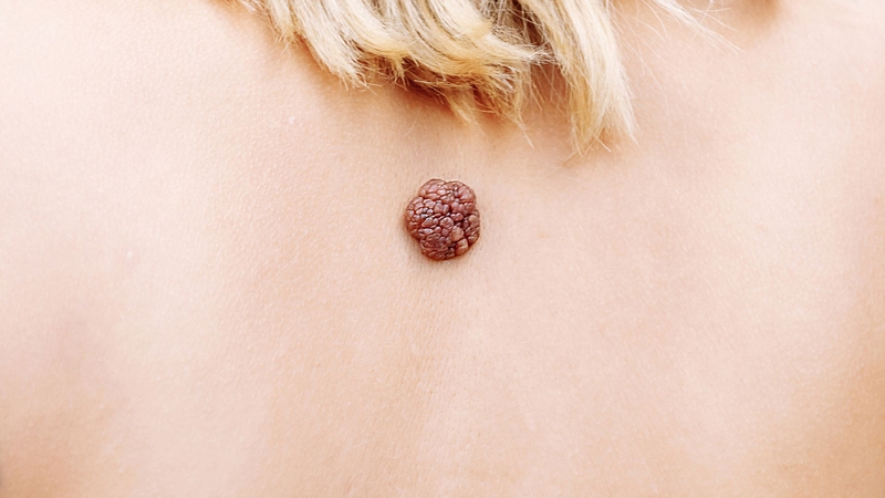 U nhú lành tính là gì? Phân loại và cách xử lý hiệu quả 3