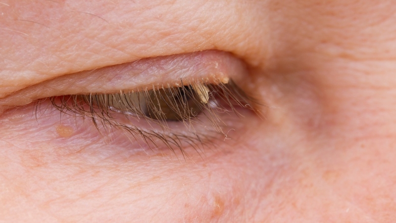 U nhú tế bào vảy: Nguyên nhân, dấu hiệu và cách điều trị 2