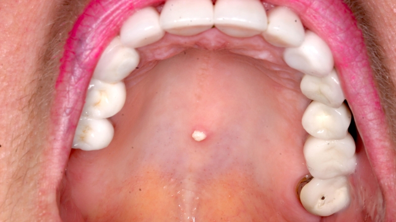 U nhú tế bào vảy: Nguyên nhân, dấu hiệu và cách điều trị 3