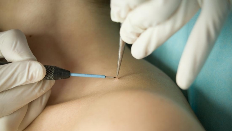 U nhú tế bào vảy: Nguyên nhân, dấu hiệu và cách điều trị 4