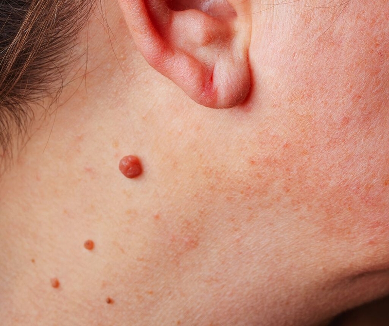 U nhú trên da có nguy hiểm hay không? Phương pháp điều trị u nhú trên da 1