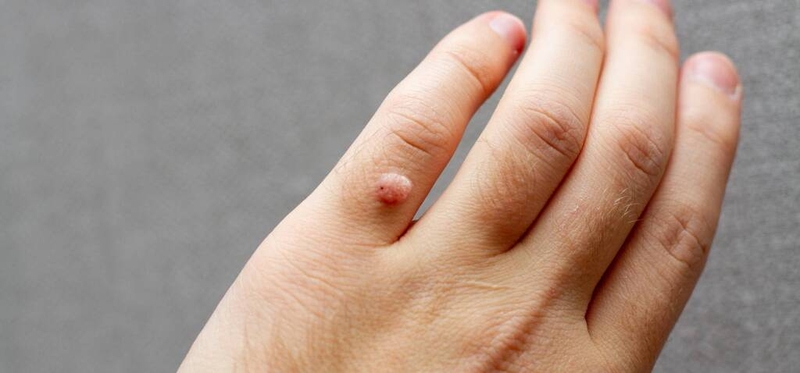 U nhú trên da có nguy hiểm hay không? Phương pháp điều trị u nhú trên da 2