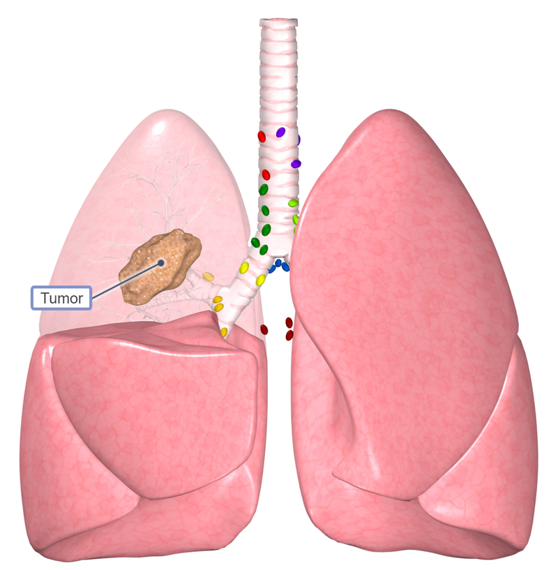U phổi có phải ung thư phổi không?2