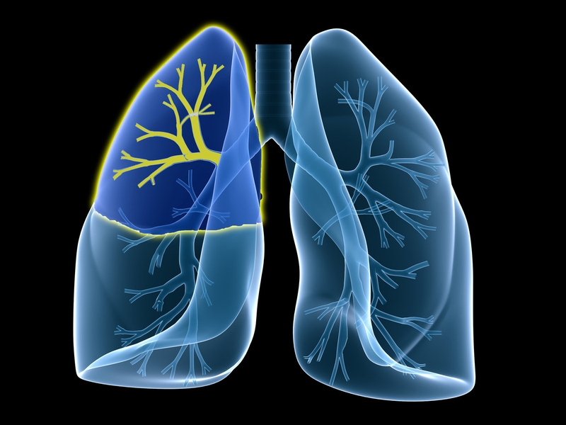U phổi có phải ung thư phổi không?3