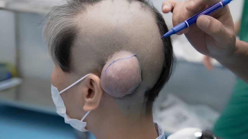 U quái có thể lành tính hoặc có thành phần ác tính