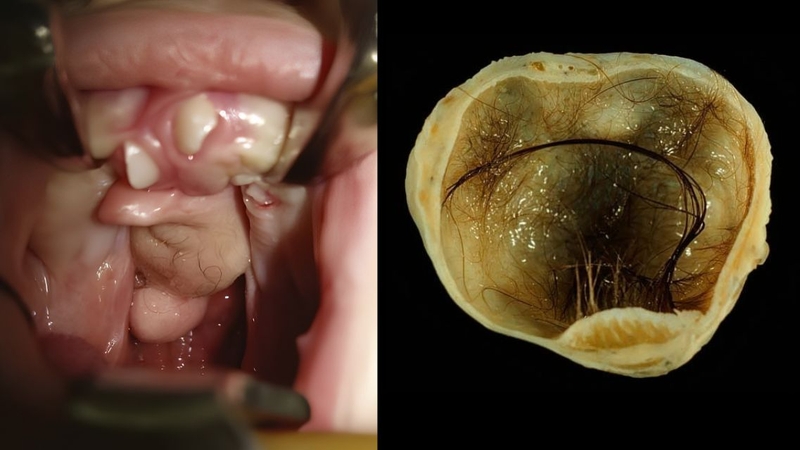 Điều trị u quái phụ thuộc vào vị trí và đặc điểm khối u