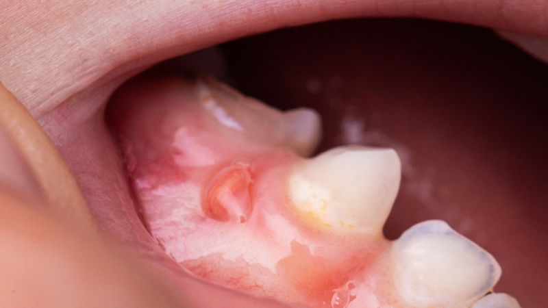 U răng phức hợp: Nguyên nhân, triệu chứng và điều trị 1