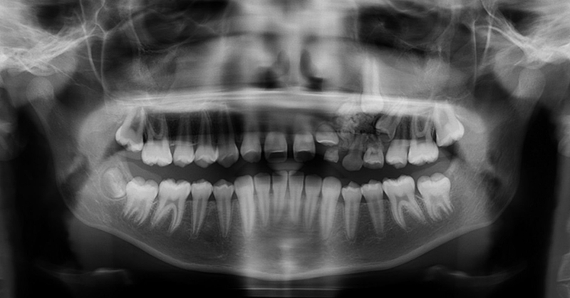 U răng phức hợp: Nguyên nhân, triệu chứng và điều trị 3