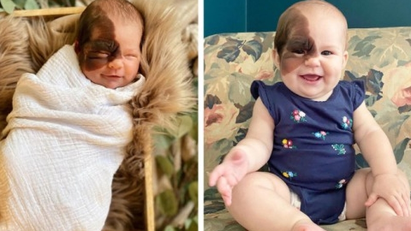 U sắc tố bẩm sinh ở trẻ em: Nguyên nhân, triệu chứng và cách điều trị 1