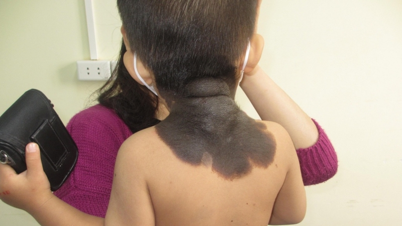 U sắc tố bẩm sinh ở trẻ em: Nguyên nhân, triệu chứng và cách điều trị 2