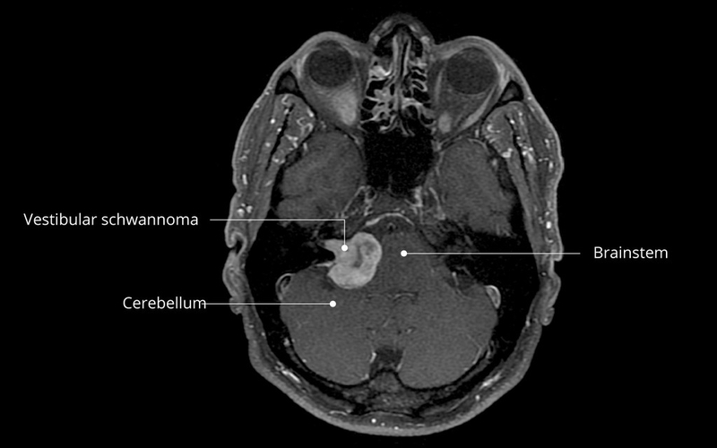 U schwannoma: Nguyên nhân, triệu chứng, chẩn đoán và phương pháp điều trị 1