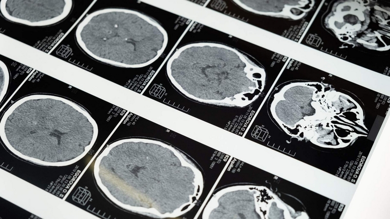 U sọ hầu có chữa được không? Làm thế nào để nhận biết dấu hiệu của u sọ hầu? 1