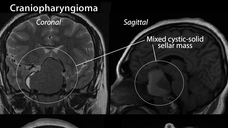 U sọ hầu: Nguyên nhân, triệu chứng và phương pháp điều trị 1