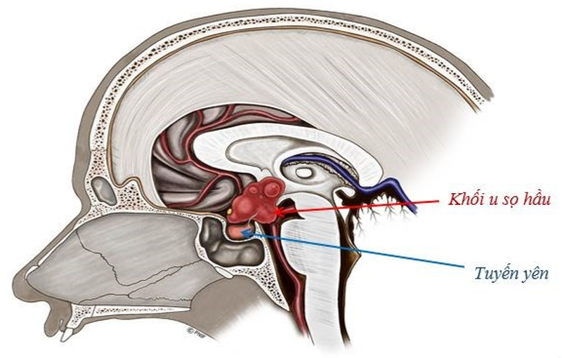U sọ hầu ở trẻ em là bệnh gì? 1
