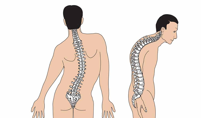 Vẹo cột sống do NF1