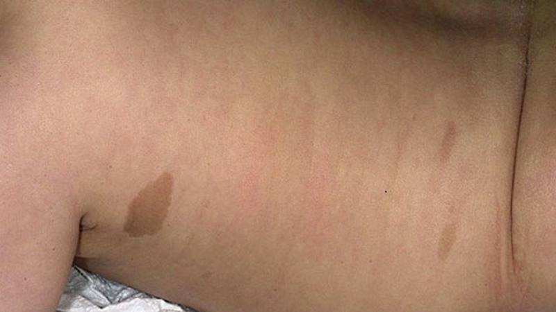 U sợi thần kinh loại 1 xuất hiện nhiều đốm màu cà phê sữa trên da