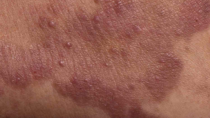 U sùi thể nấm: Nguyên nhân, triệu chứng và hướng điều trị 1