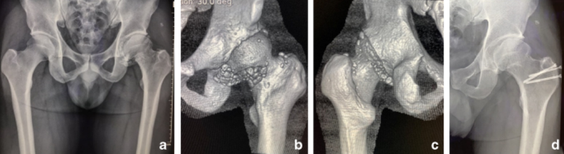 U sụn lấp đầy khớp háng có chữa được không? 5