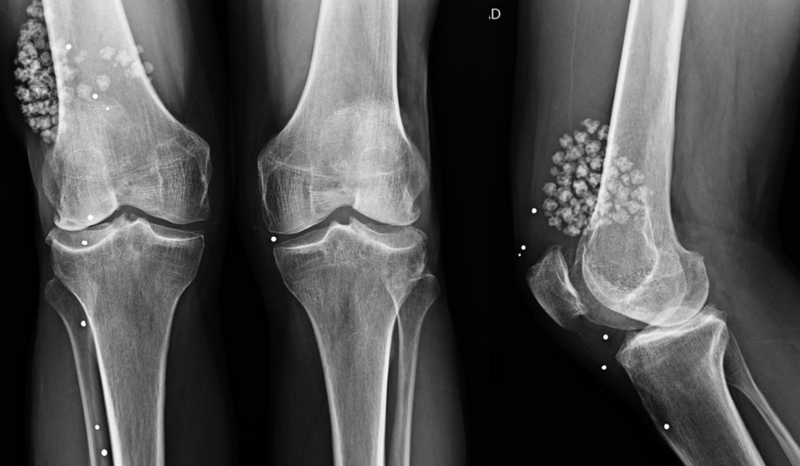 U sụn màng hoạt dịch: Chẩn đoán và chữa trị bệnh 1