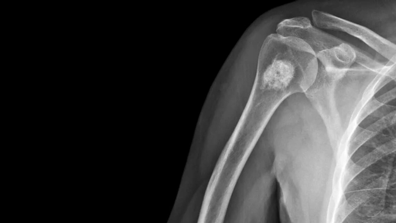 U sụn xương ở trẻ em: Dấu hiệu nhận biết, chẩn đoán và điều trị 2