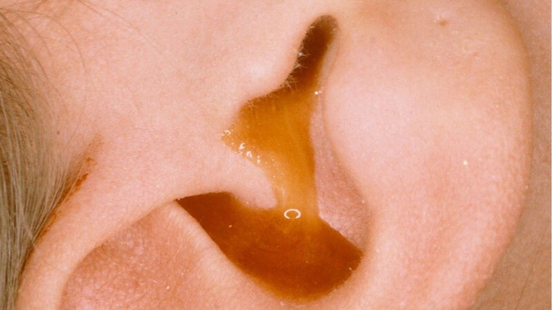 Ù tai do viêm tai giữa có nguy hiểm không 1