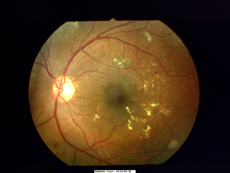 Ù tai mắt mờ gặp trong bệnh lý gì 2