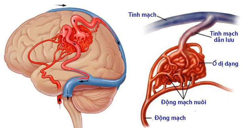 Ù tai mệt mỏi là dấu hiệu của bệnh gì? 3