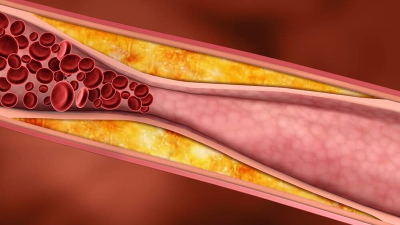 Ù tai vận mạch là gì? Nguyên nhân và cách phòng ngừa 1