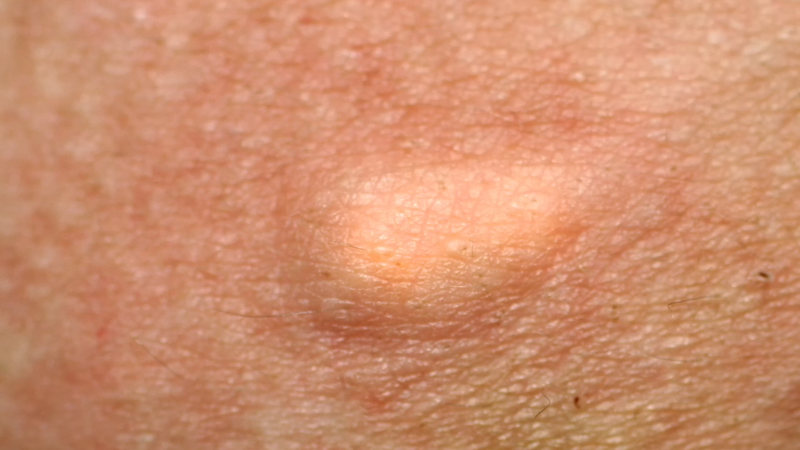 U tân sinh là gì Đây là thuật ngữ dùng để chỉ sự tăng sinh bất thường của tế bào, dẫn đến hình thành một khối mô mới trong cơ thể