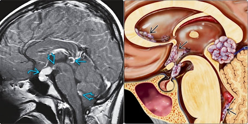 U tế bào mầm ở trẻ em: giới thiệu1