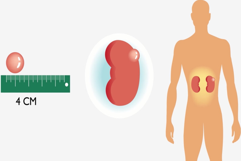 U thận có nguy hiểm tới tính mạnh không? Nguyên nhân, triệu chứng và biện pháp phòng ngừa 1