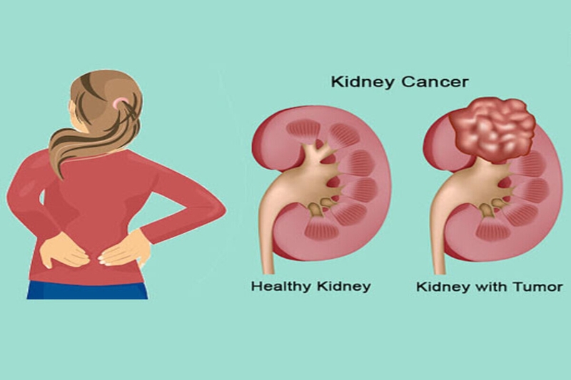 U thận có nguy hiểm tới tính mạnh không? Nguyên nhân, triệu chứng và biện pháp phòng ngừa 2