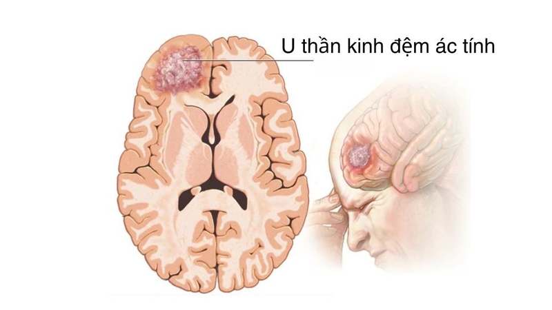 U thần kinh đệm ác tính: Dấu hiệu nhận biết, nguy cơ và cách điều trị 1