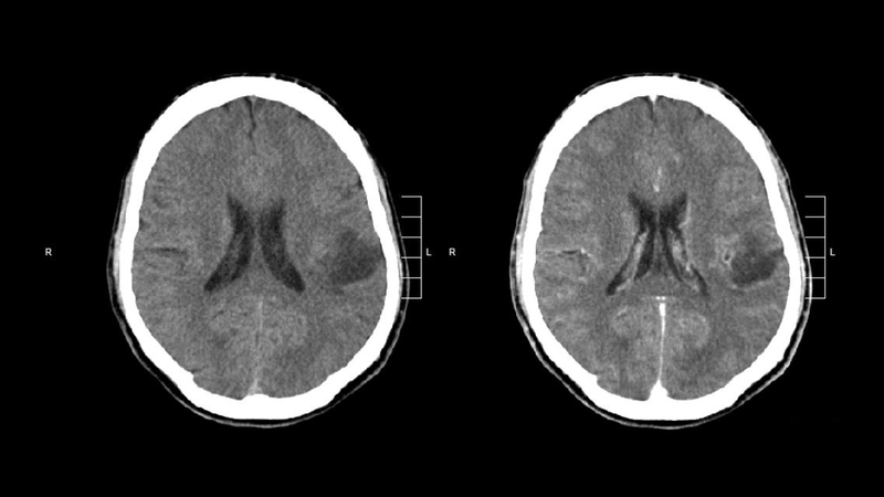U thần kinh đệm ác tính: Dấu hiệu nhận biết, nguy cơ và cách điều trị 2