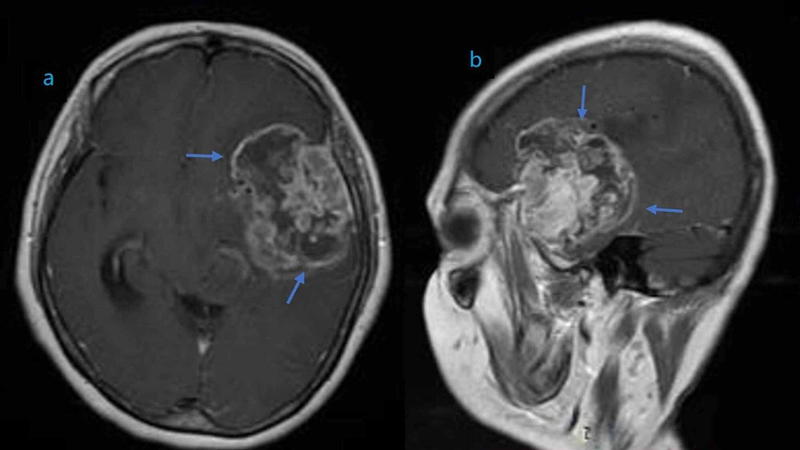 u-than-kinh-dem-bac-cao-la-gi-phuong-phap-dieu-tri-u-than-kinh-dem-bac-cao 1