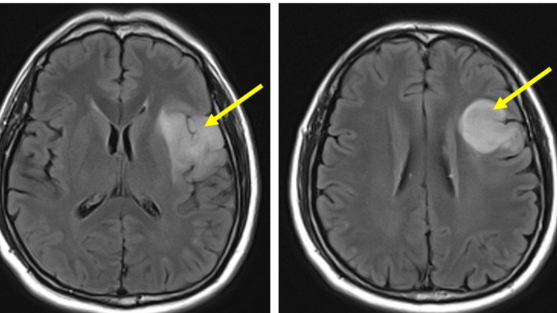 u-than-kinh-dem-bac-thap-la-gi-trieu-chung-va-cach-chan-doan-u-than-kinh-dem-bac-thap 1