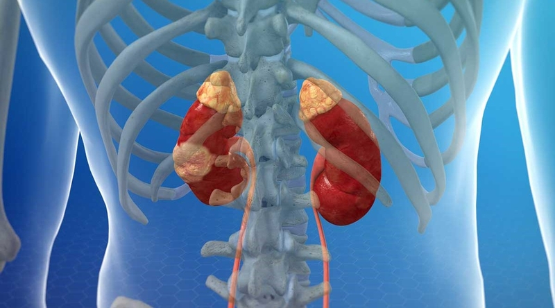 U thận là gì? Những cách nhận biết và điều trị u thận hiệu quả 1